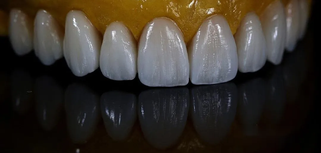 A row of porcelain veneers on a model, reflected on black