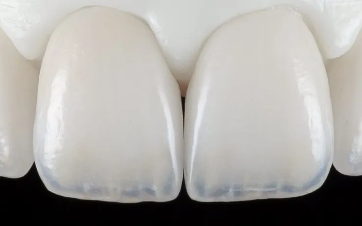Two porcelain front teeth on a model