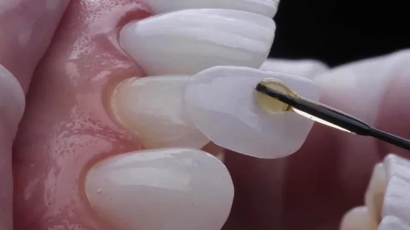 A porcelain veneer tried on a front tooth, held on an applicator