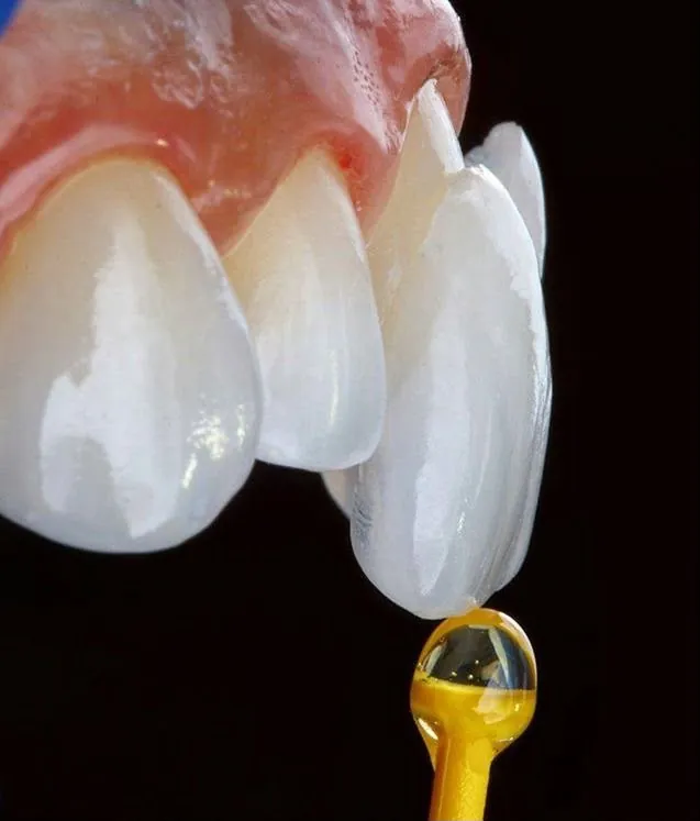 A thin porcelain veneer on an applicator beside the teeth