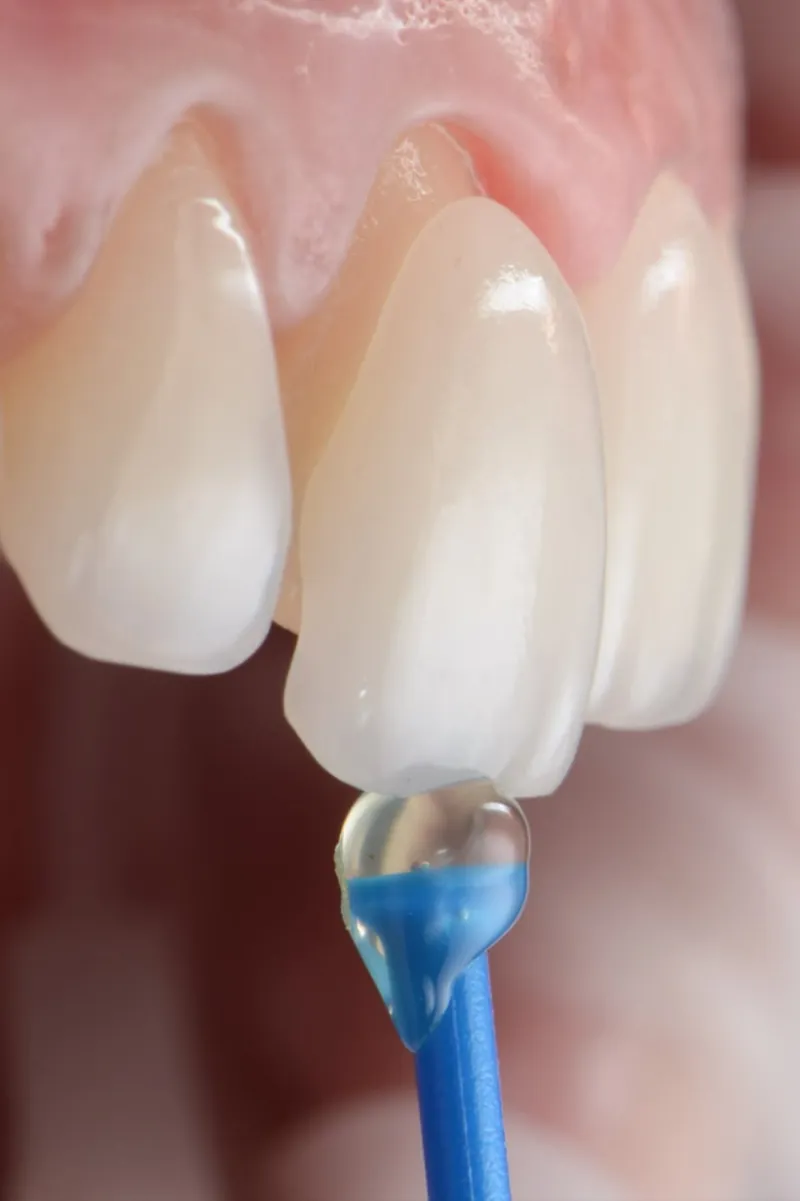 A porcelain veneer held on an applicator in front of the teeth
