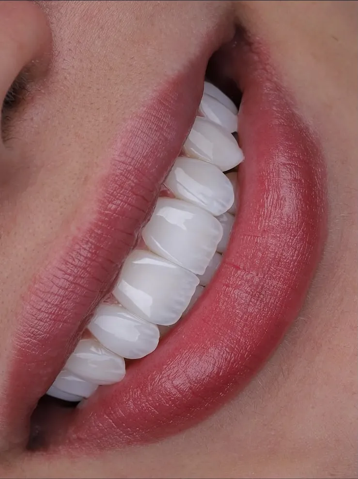 A smile with porcelain veneers, close up