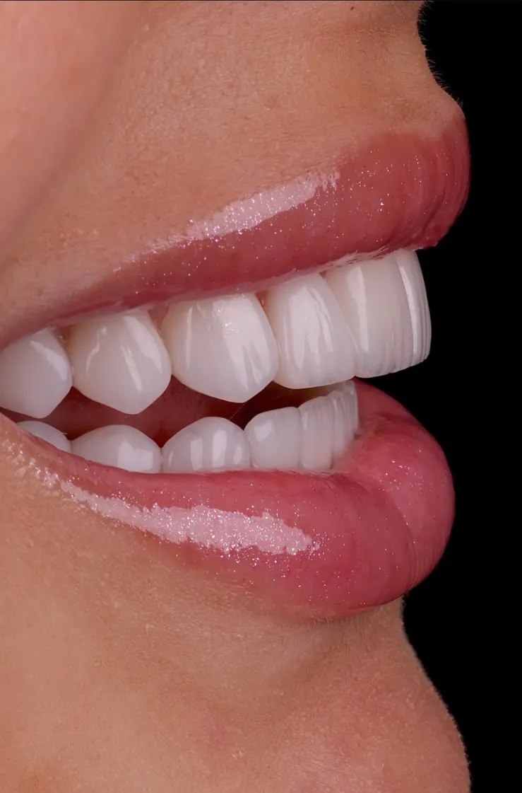 Veneers in profile, lips parted