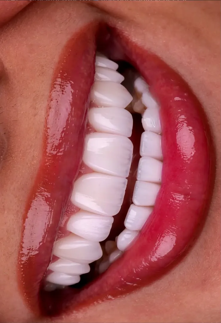 Veneers between red lips
