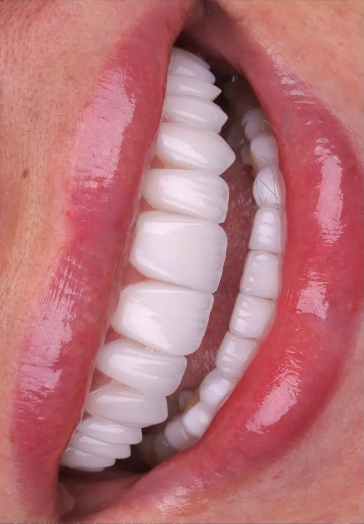 A smile with porcelain veneers, seen from the side