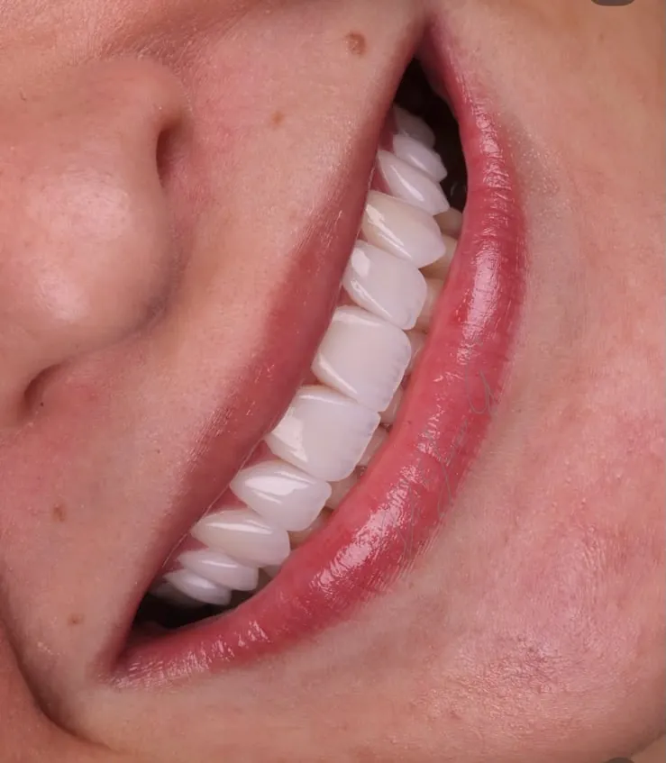A smile with veneers, head turned