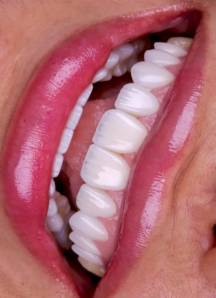 A wide smile with veneers, close up