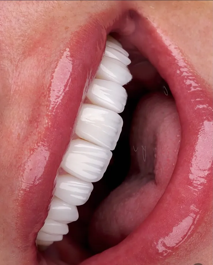 Veneers in an open smile