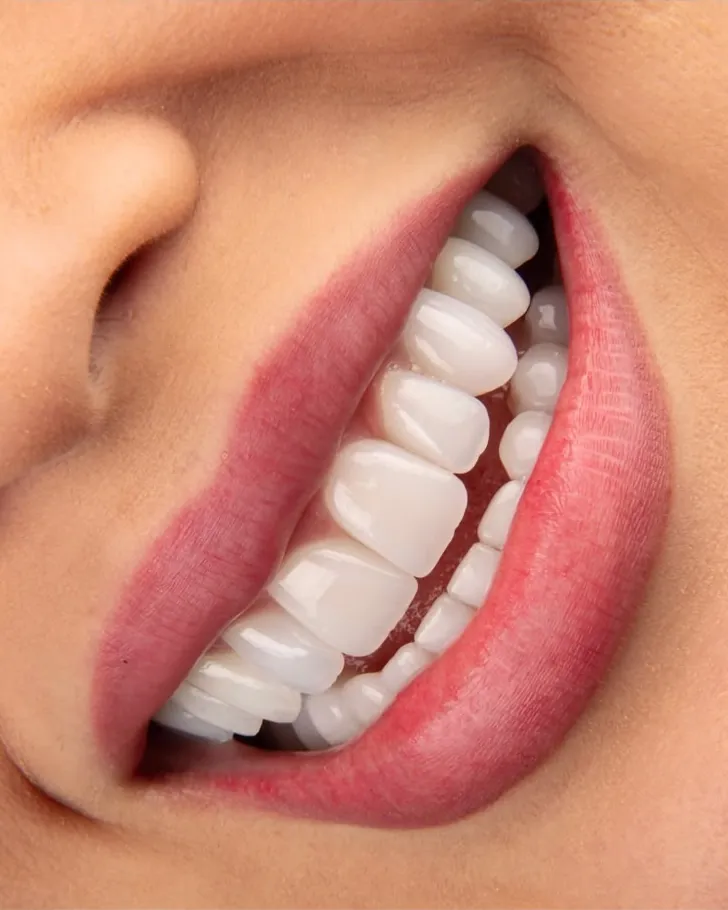 A smile with veneers, seen from the side