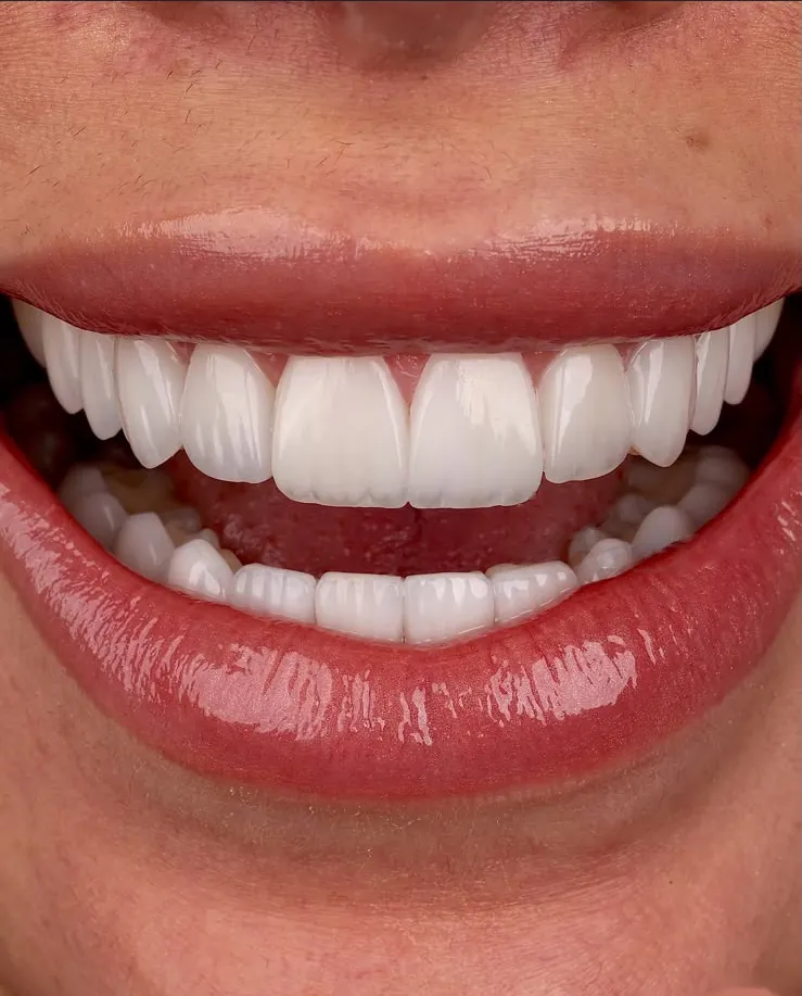 A full smile with veneers, front on