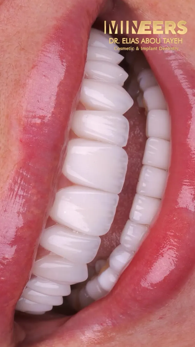 A smile with porcelain veneers, Mineers, Dr. Elias Abou Tayeh