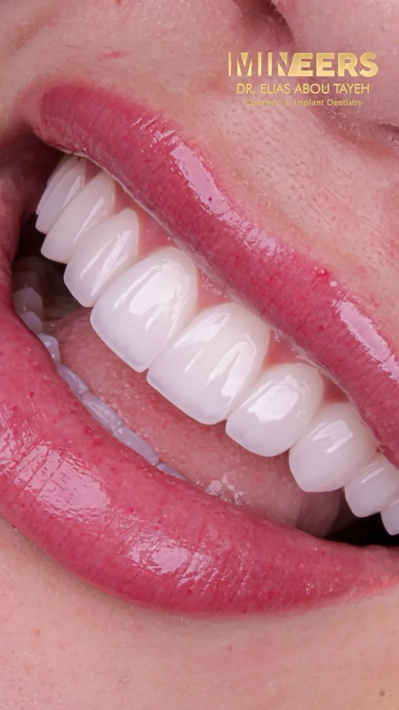 A laughing smile with porcelain veneers, Mineers, Dr. Elias Abou Tayeh