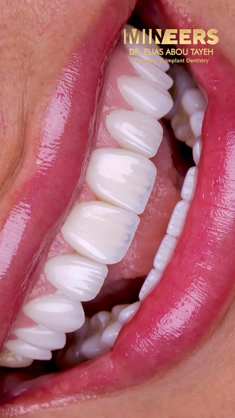 A smile with porcelain veneers, Mineers, Dr. Elias Abou Tayeh