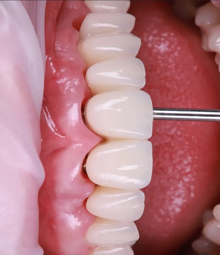 Crowns on implants, checked at the gum line with a probe