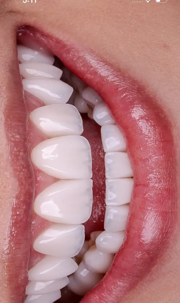 Veneers in profile, lips drawn back