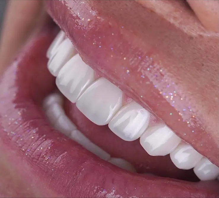 Veneers and glossy lips, close up