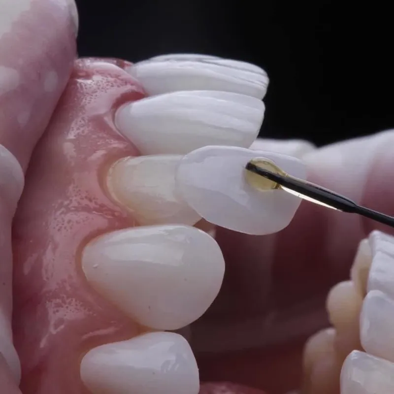 A porcelain veneer tried on a front tooth, held on an applicator
