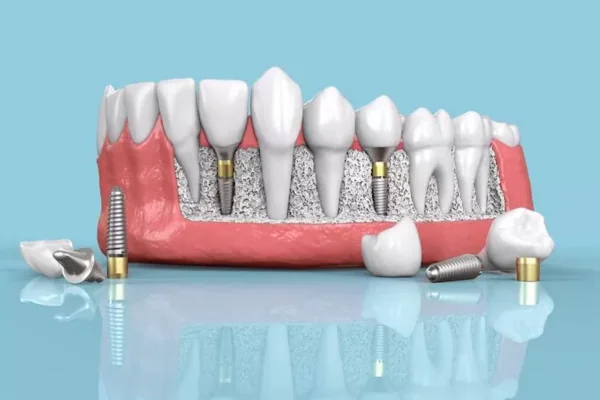 Dental Implants vs Dental Bridges: Key Differences Explained