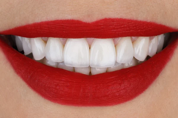 What to Eat After Getting Porcelain Veneers: A Complete Diet Guide