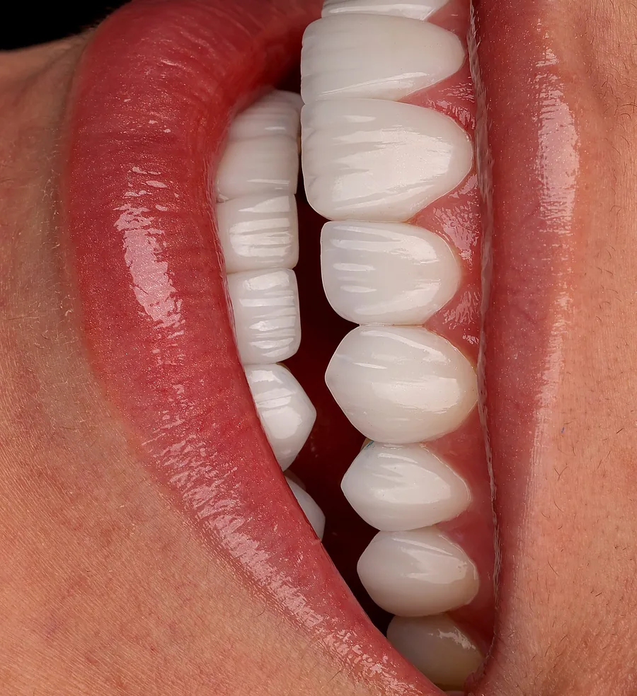 Gum & Tooth Harmony — smile design result at Mineers Smile Center Beirut, Lebanon