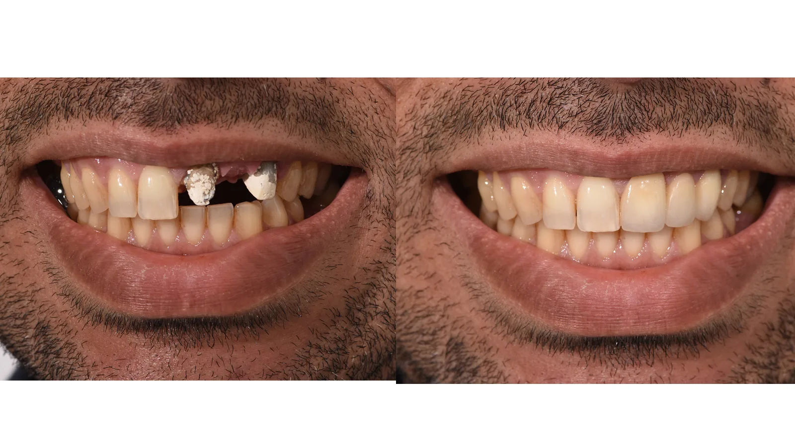 Dental Crowns