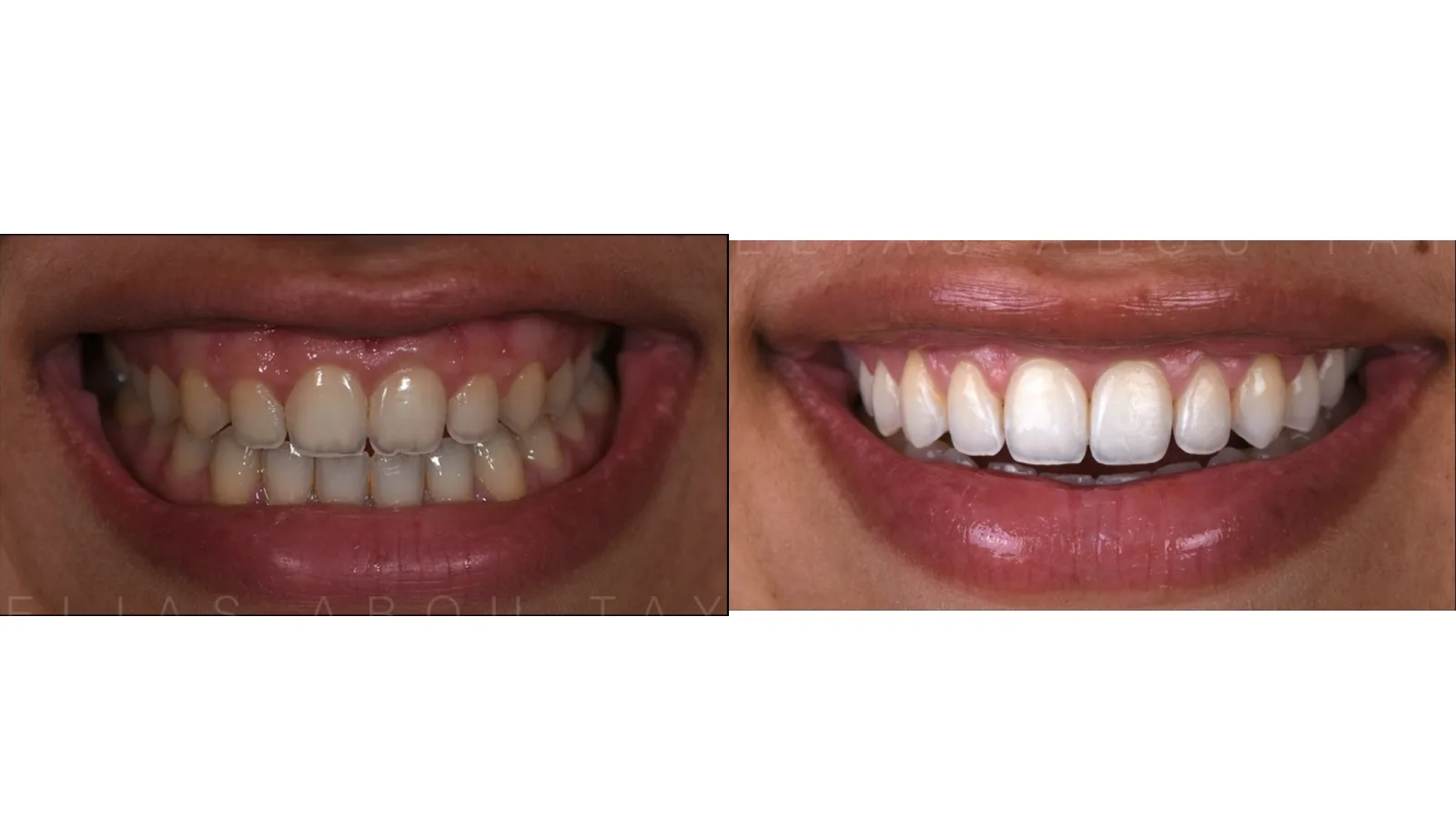 Teeth Whitening