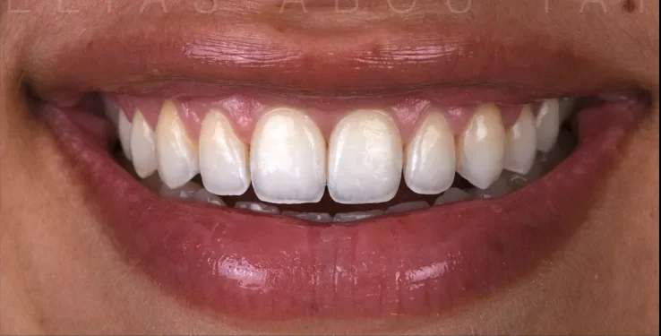 Close-up of a balanced smile after gummy smile correction at Mineers