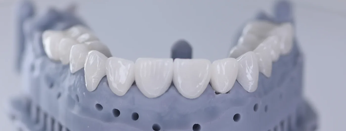 A 3D-printed mock-up of a designed smile at Mineers