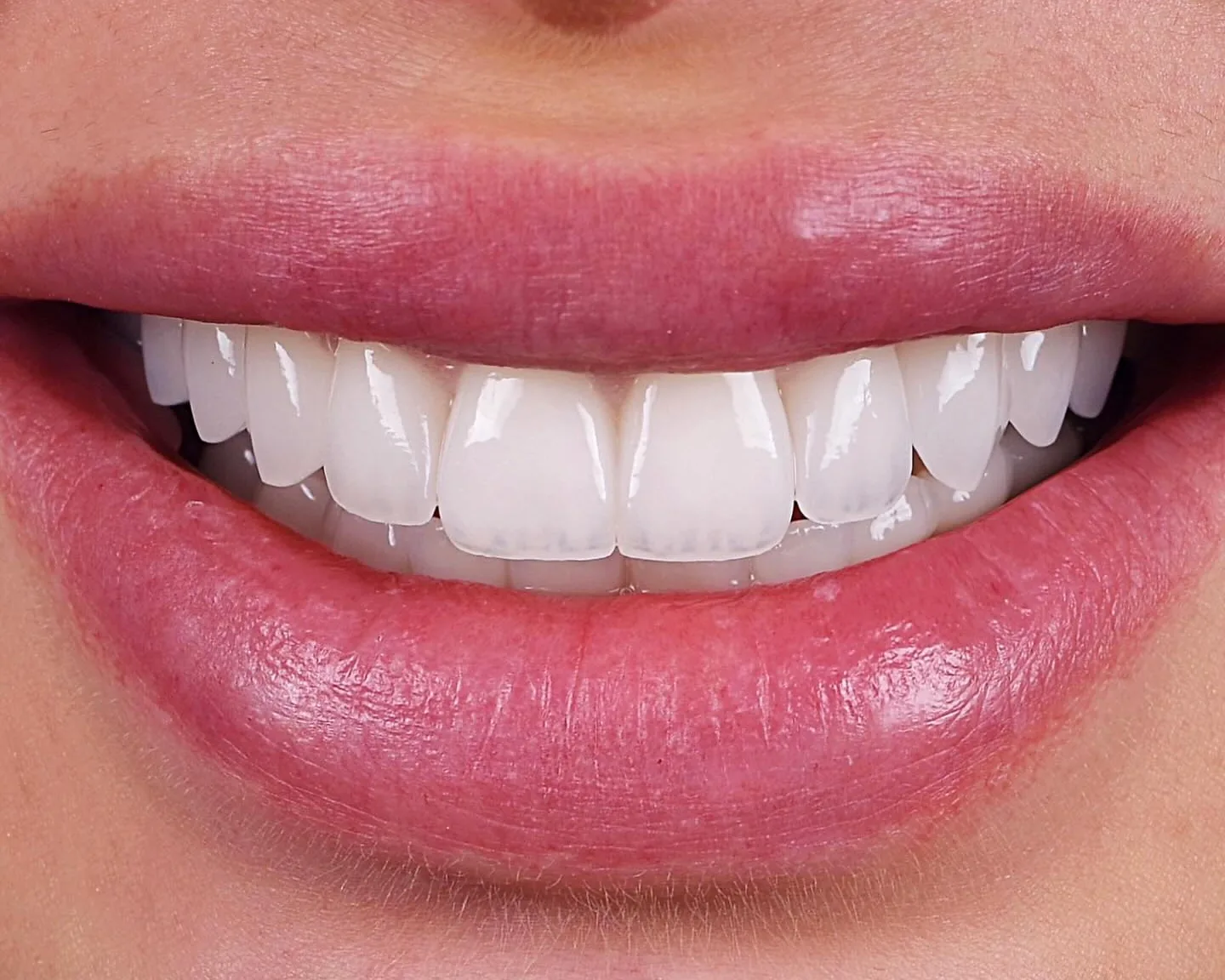 The smile of a Mineers patient after porcelain veneers