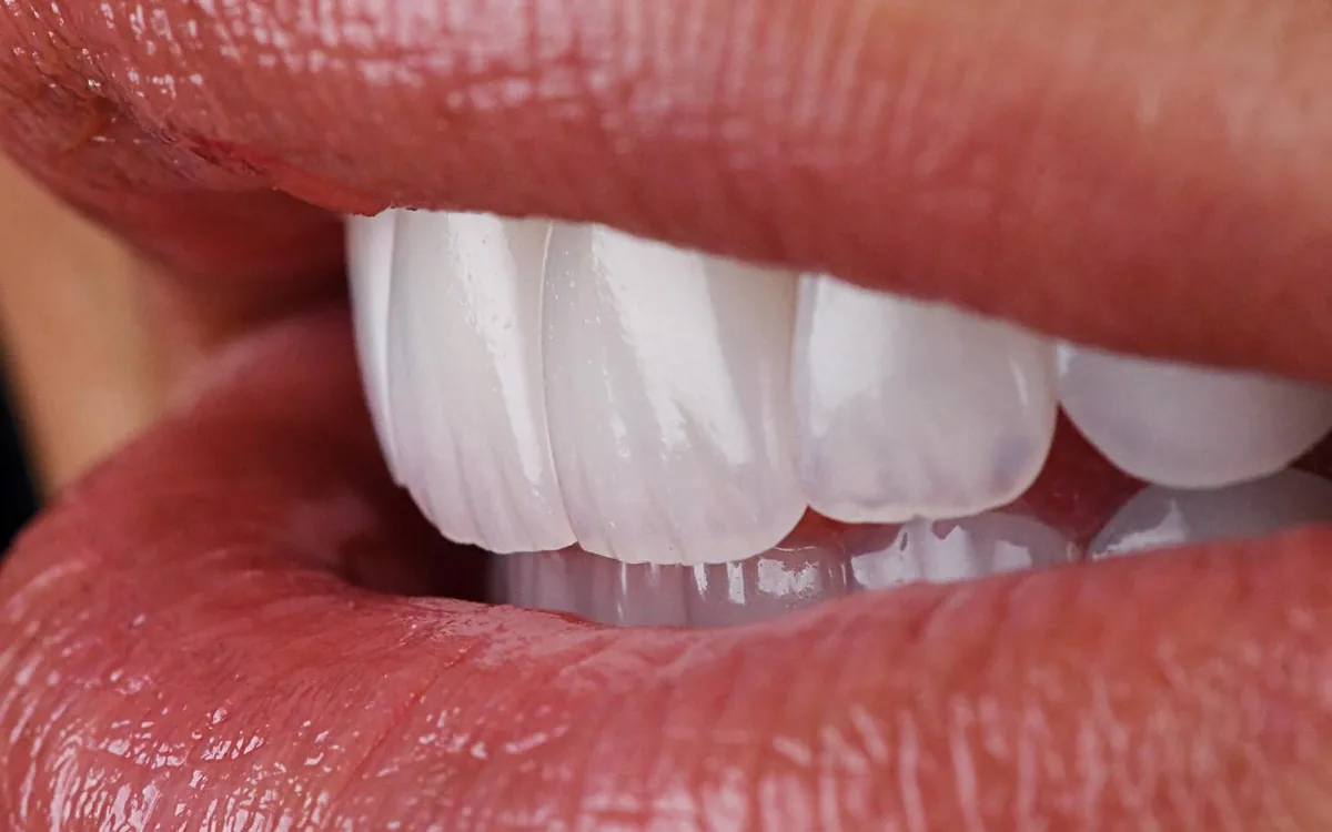 Porcelain veneers, in profile