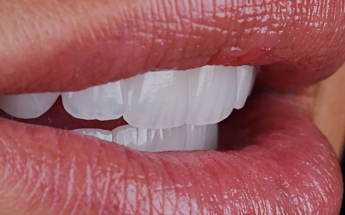 Porcelain veneers, in profile