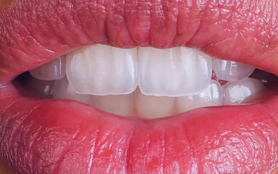 Porcelain veneers, close up