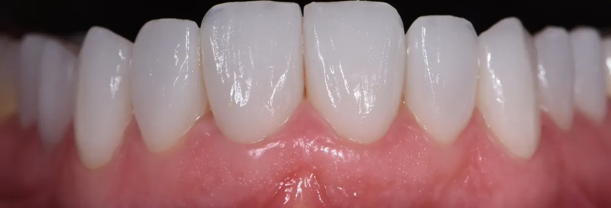 Porcelain veneers, close up
