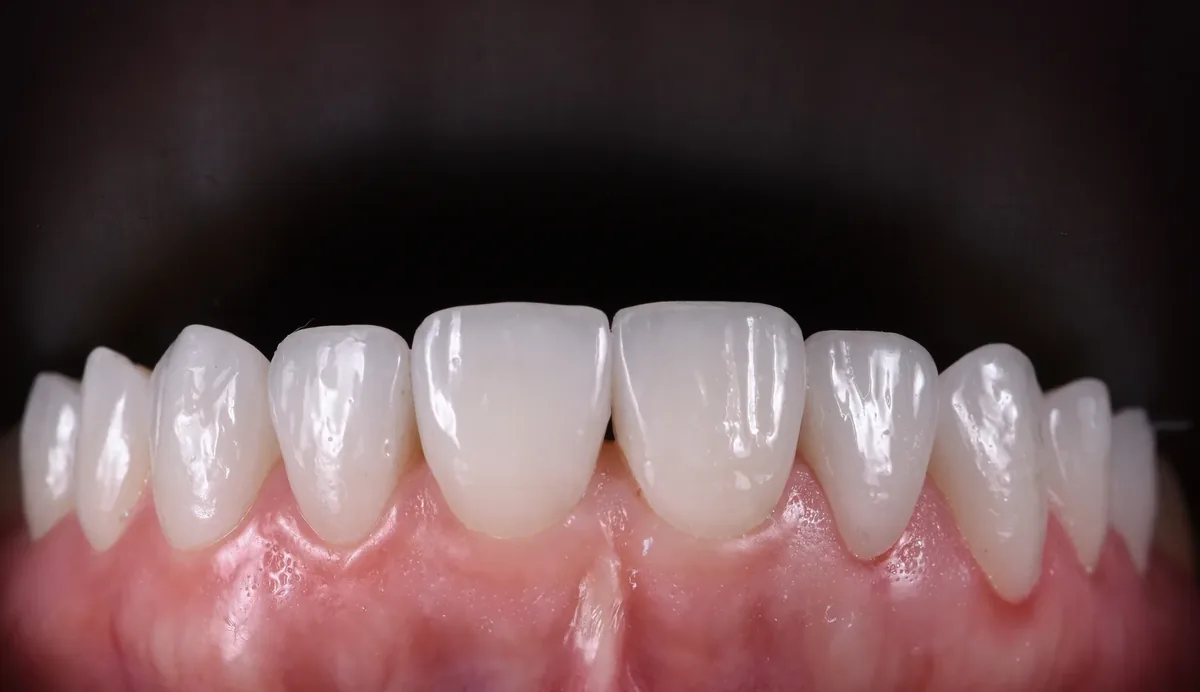 Porcelain veneers, close up