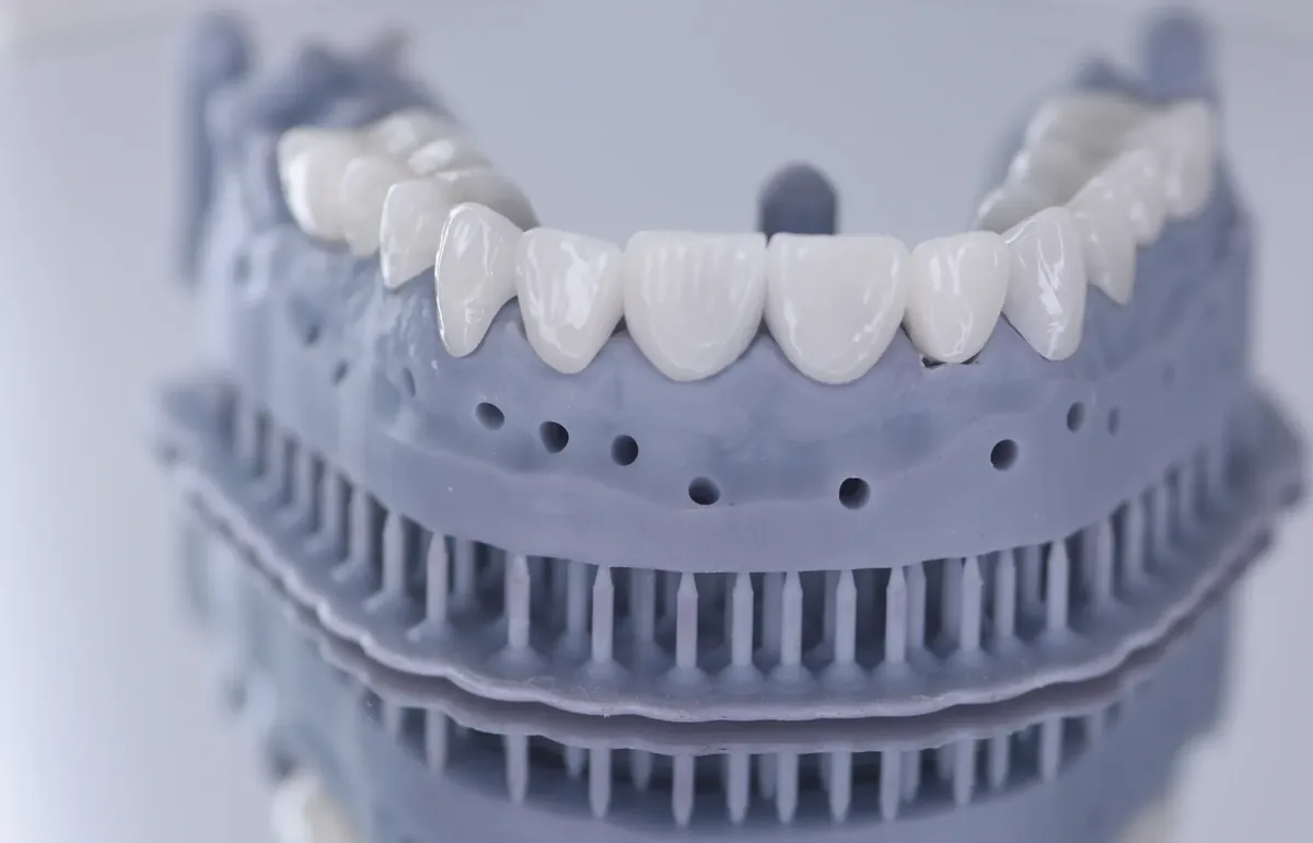 Veneers on a printed model