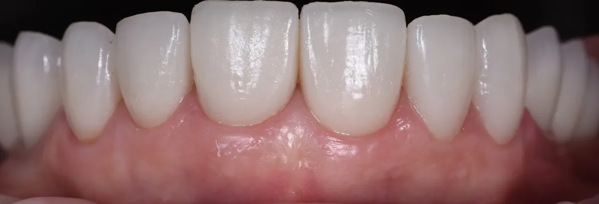 Porcelain veneers, close up