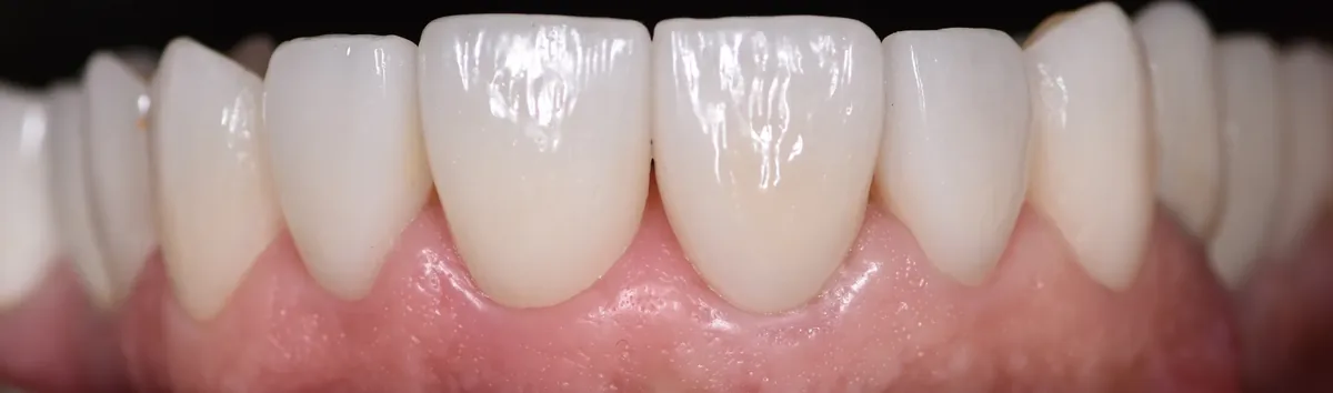 Porcelain veneers, close up