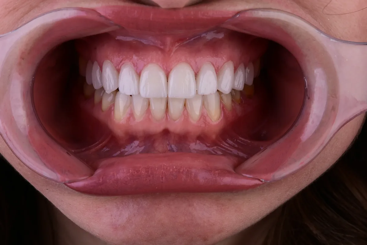 Porcelain veneers