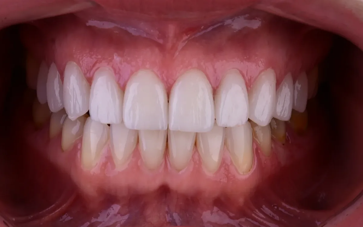 Case 19, after: Porcelain veneers