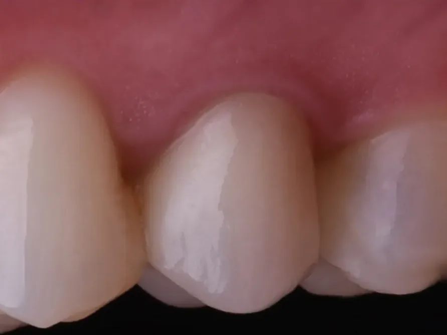 Case 22, after: Restorations
