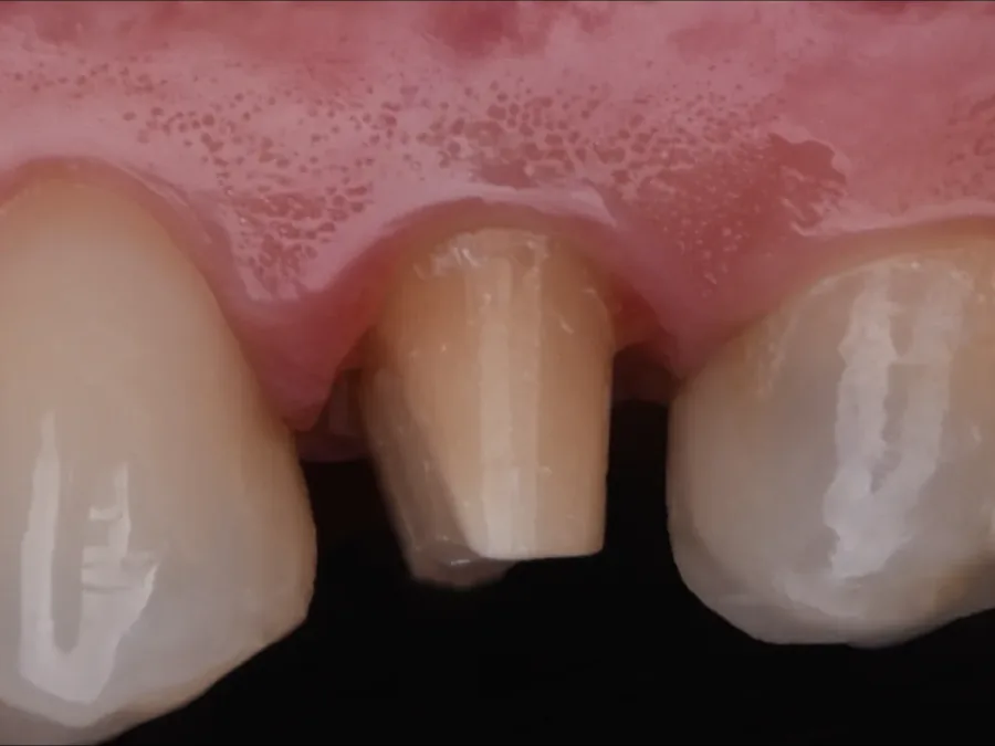 Case 22, before