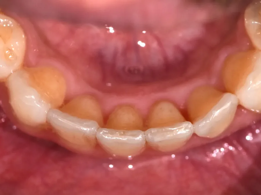 Case 20, after: Fixaligner&reg;
