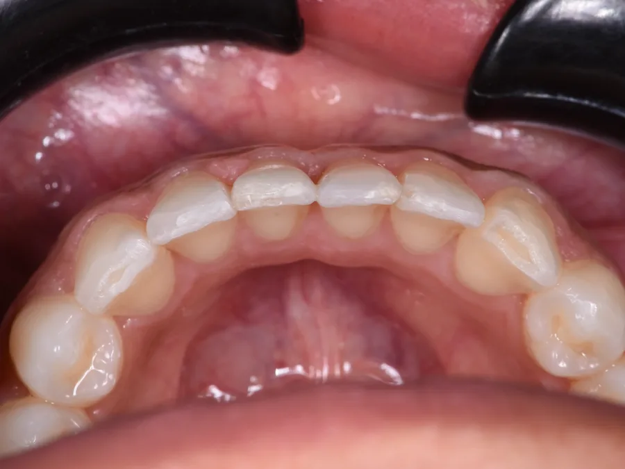 Case 21, after: Fixaligner&reg;