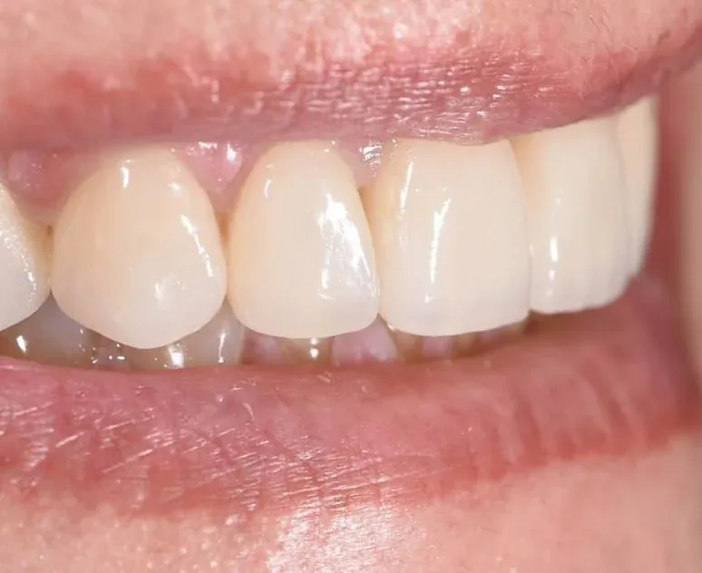 Case 10, after: Porcelain veneers