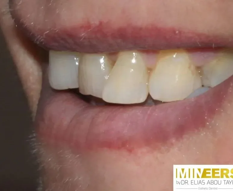Case 10, before