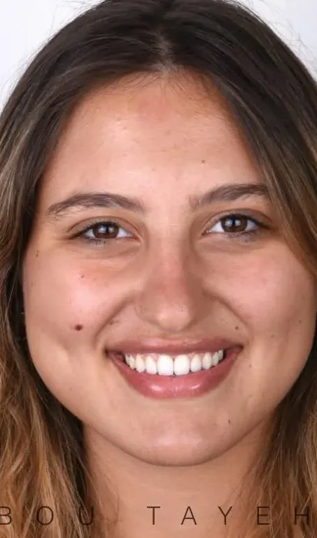 Case 27, after: Gummy smile