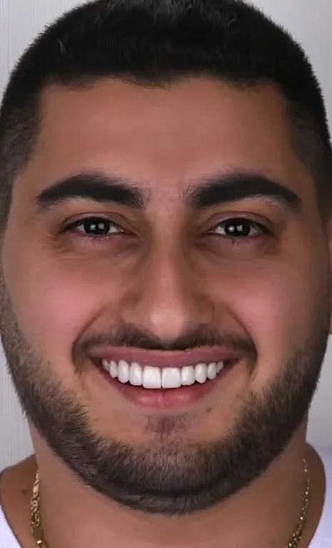 Case 11, after: Porcelain veneers