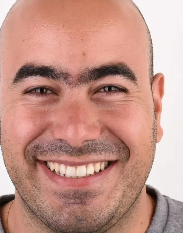 Case 05, after: Porcelain veneers