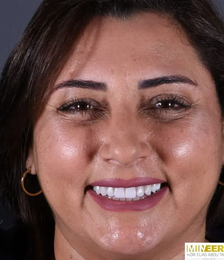 Case 07, after: Porcelain veneers