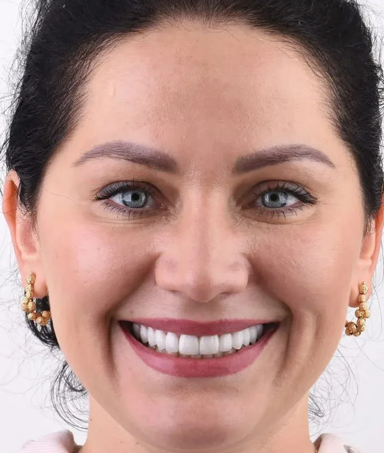 Case 08, after: Porcelain veneers